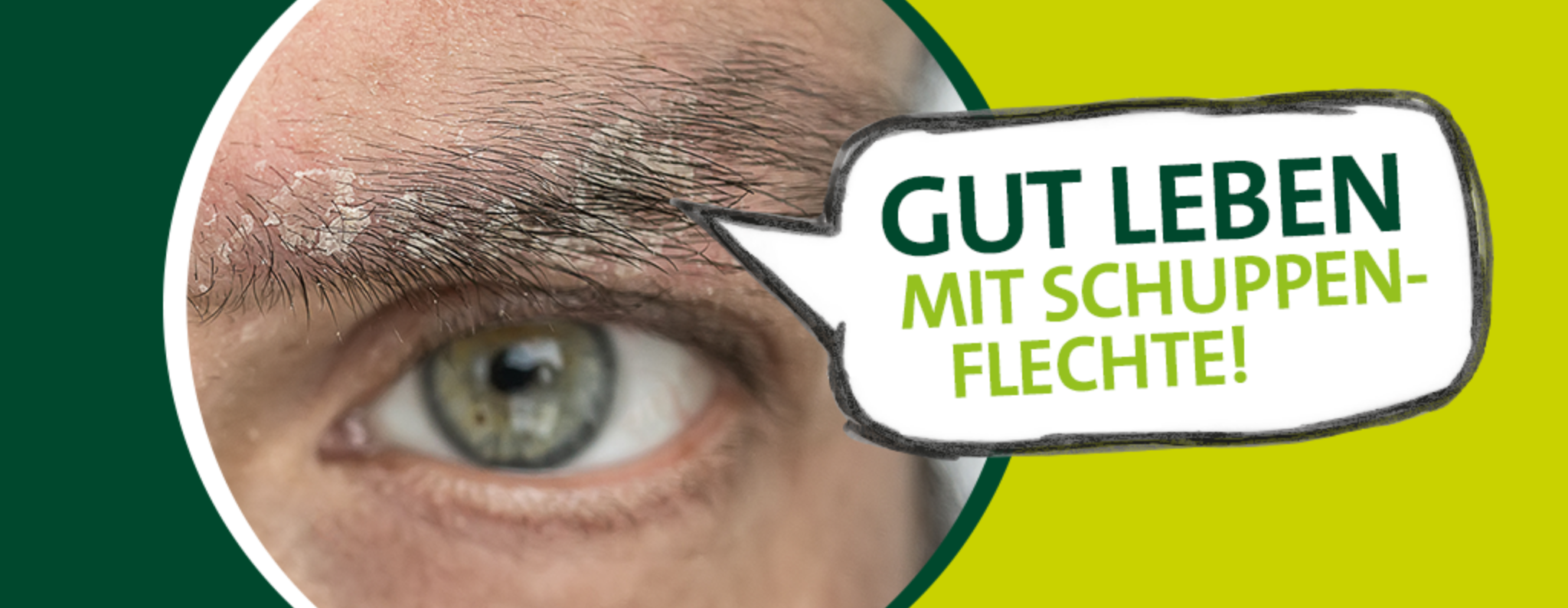 Schuppenflechte Ratgeber